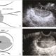 Transvaginal Ultrasound Staging of Cervical Cancer