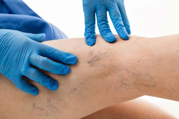 The Use Of Ultrasound Scanner With Varicose Veins