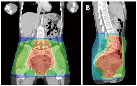 Lowering Radiotherapy Toxicities Following a Pelvic Cancer Diagnosis