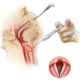 Laser-Assisted Microsurgery of the Vocal Fold