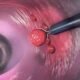 Laser-Guided Assessment of Polyps