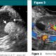 US Characterization and Reporting of Adnexal Masses