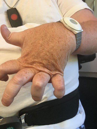 Robot Gloves for Hemiplegia Finger Rehabilitation