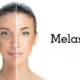 Laser Therapy for Melasma