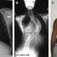 Laser Treatment for Idiopathic Scoliosis