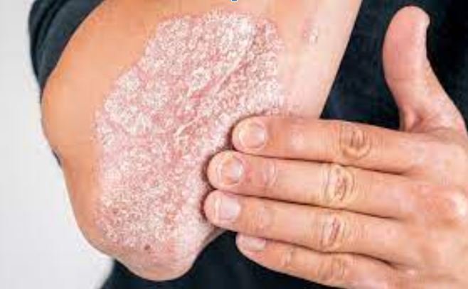 Laser Treatment for Psoriasis Issue