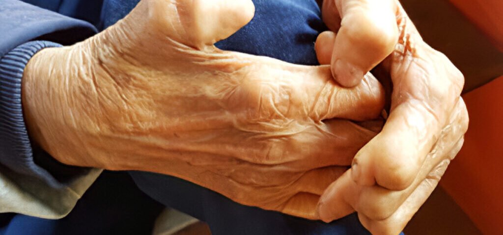 Hand Rehabilitation for Leprosy