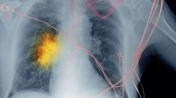 Laser Therapy for Non-Small Cell Lung Cancer