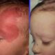 Removing Birthmarks with Laser Therapy