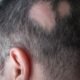 Treating Alopecia with Laser Therapy