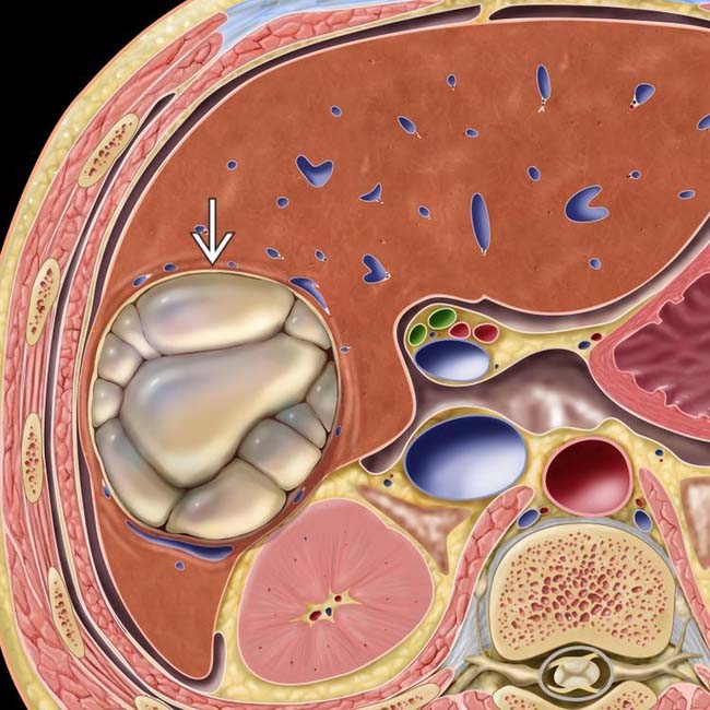 Ultrasound-Guided Hydatid Cyst Diagnosis