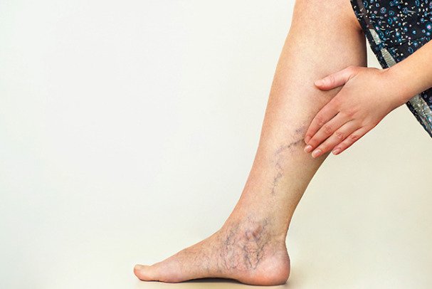 Vein Finders and Vein Weakness: Venous insufficiency