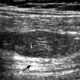 The Use of Ultrasound Scanner in Guiding Fat Gray Intramuscular