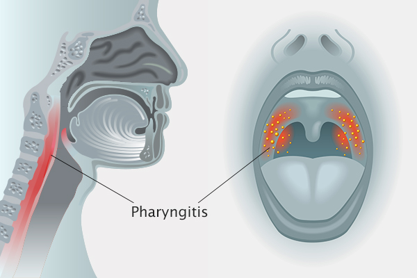 Faryngitt Ultralyddiagnose