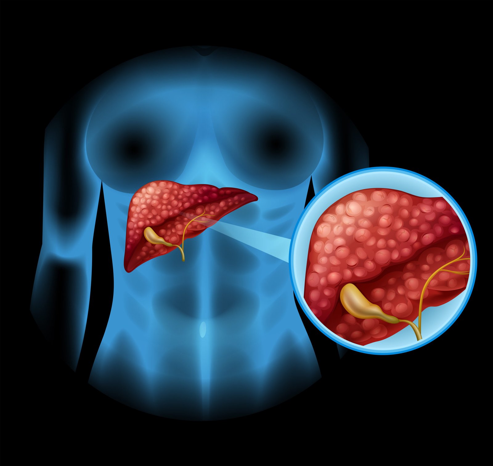 Diagnosing Gallstones with Ultrasound Scanning