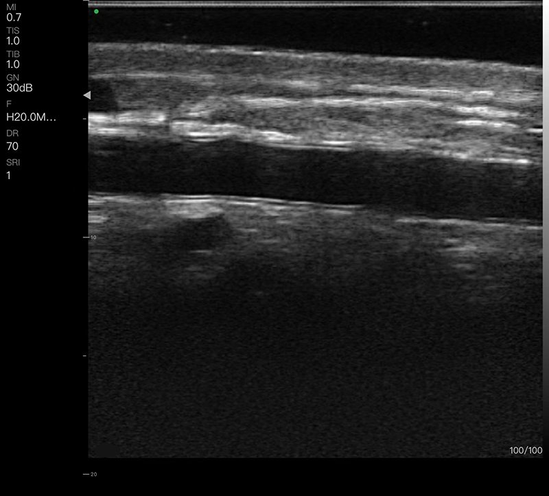 High-Frequency Linear Ultrasound machine