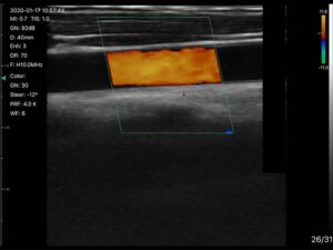 Phased Array & Linear Doppler Ultrasound Machine